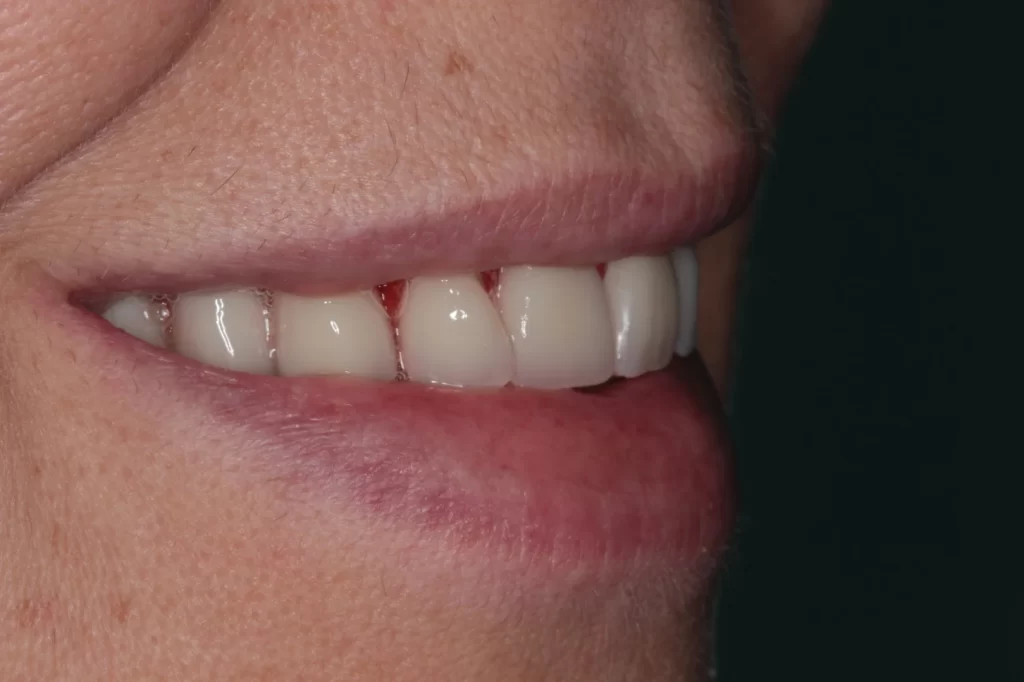 Conforto e segurança com implantes dentários