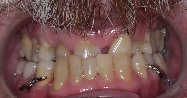 Sorriso inicial