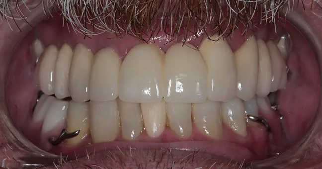 Coroas em porcelana superiores