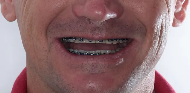 Sorriso inicial