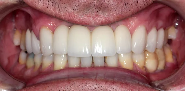 Coroas em porcelana superiores