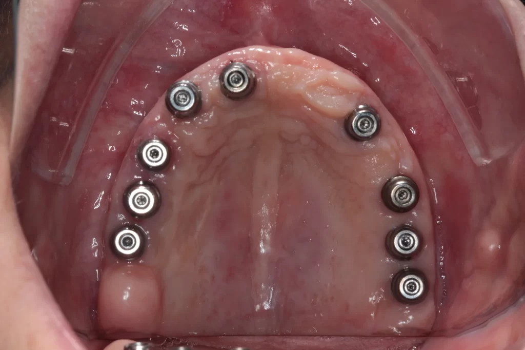 Implantes bem distribuidos. Note a saúde gengival