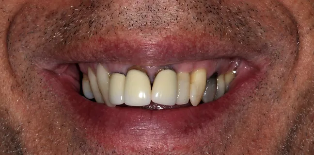 Sorriso inicial