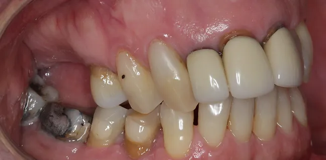 Sorriso inicial