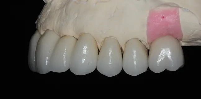 Coroas em porcelana superiores - prontas para instalar