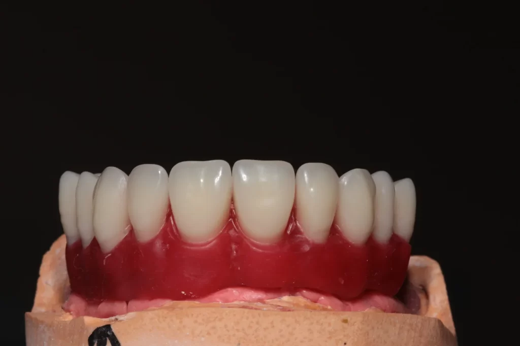 Fase de provas - montagem inicial dos dentes