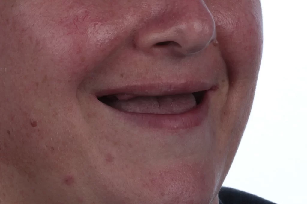 Situação inicial - ausência de dentes superiores
