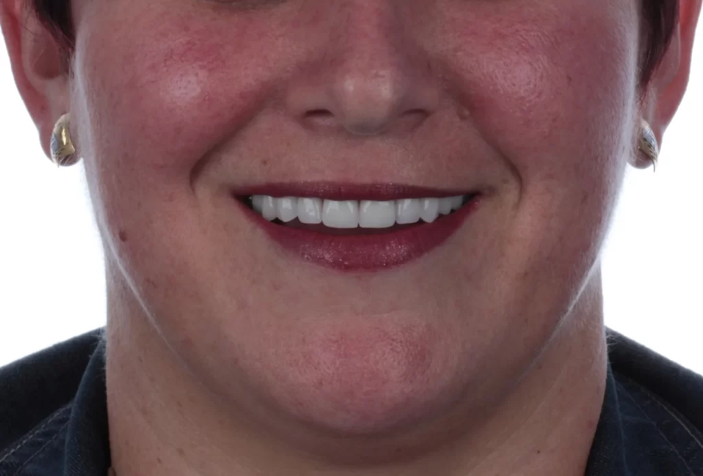 Instalação dos dentes após 48h da cirurgia de implantes